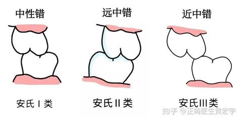 安氏Ⅱ类错HE畸形的图解与临床解析